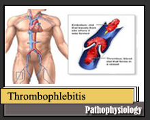 thrombophlebitis migrans