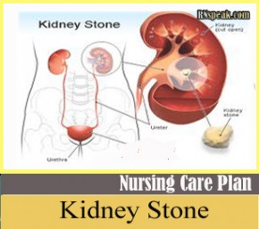 right renal calculus