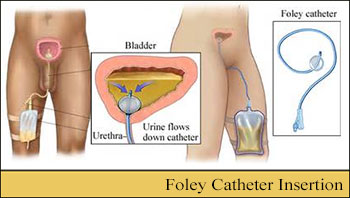 How do nurses perform a Foley catheter insertion?