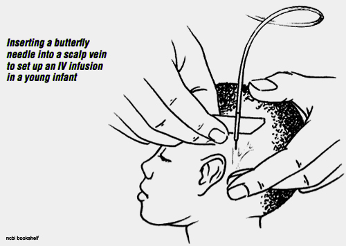 scalp-vein-infusion-insertion for pediatric