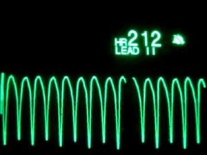 ecg-picture