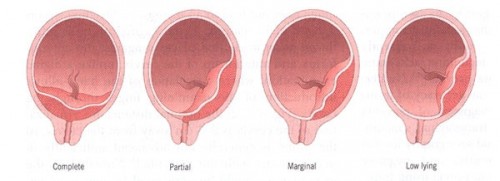 placenta-previa-nursing-management