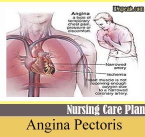 Angina chest pain