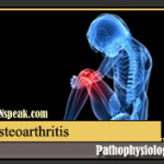 Osteoarthritis Pathophysiology