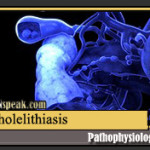 Cholelithiasis (Gallstone)