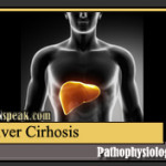 Pathophysiology Liver Cirhosis