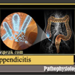 Appendicitis pathophysiology