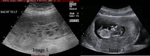 Ultrasound image of Hmole