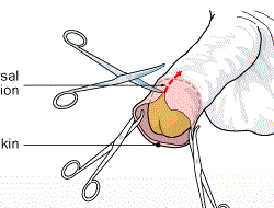 dorsal incision circumcision