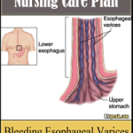 Bleeding Esophageal Varices Nursing Care Plan