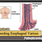 Bleeding Esophageal Varices Pathopgysiology