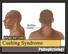 Cushing-syndrome-pathophysiology | RNspeak