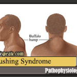cushing-syndrome-pathophysiology
