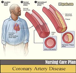 Nursing Care Plan for Coronary Artery Disease