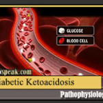 diabetic-ketoacidosis-pathophysiology