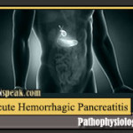 pancreatitis-pathophysiology