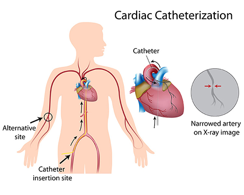 cardiaccatheterization-pre-and-post-operation-care-patient