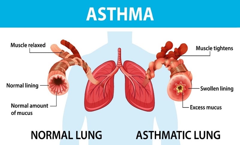 Asthma Pathophysiology And Schematic Diagram