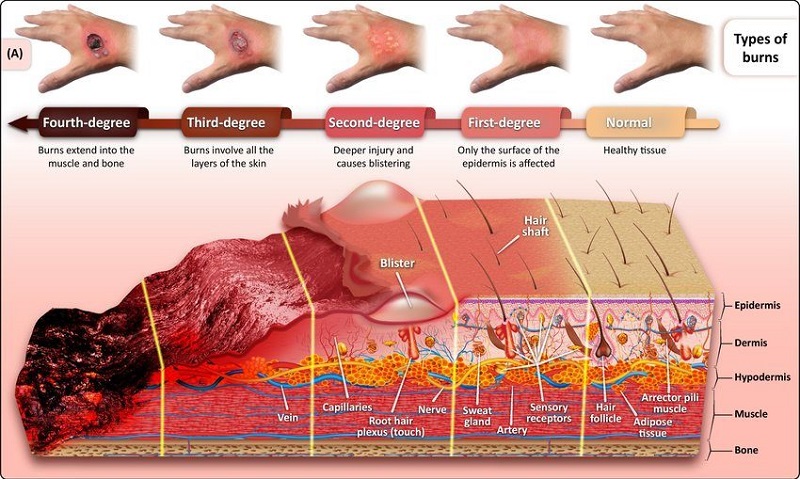 burn classification of injuries