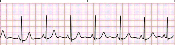 The 6 Steps Method On How To Interpret Electrocardiogram Results EASILY ...