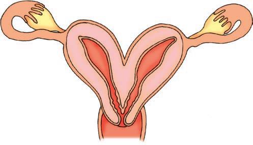 uterus malformation