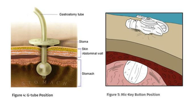 PEG Tube Placement Procedure Nursing Care Health Education