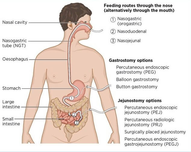 PEG Tube Placement Procedure Nursing Care Health Education   Peg Anatomy 