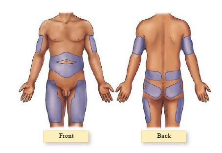 insulin injection site