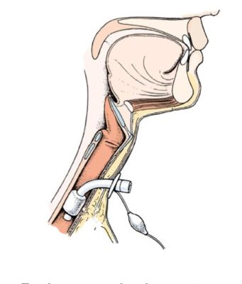 Tracheostomy Procedure And Nursing Diagnoses [ Updates]