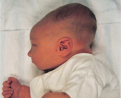 Newborn Nursing Diagnosis and Immediate Care Management